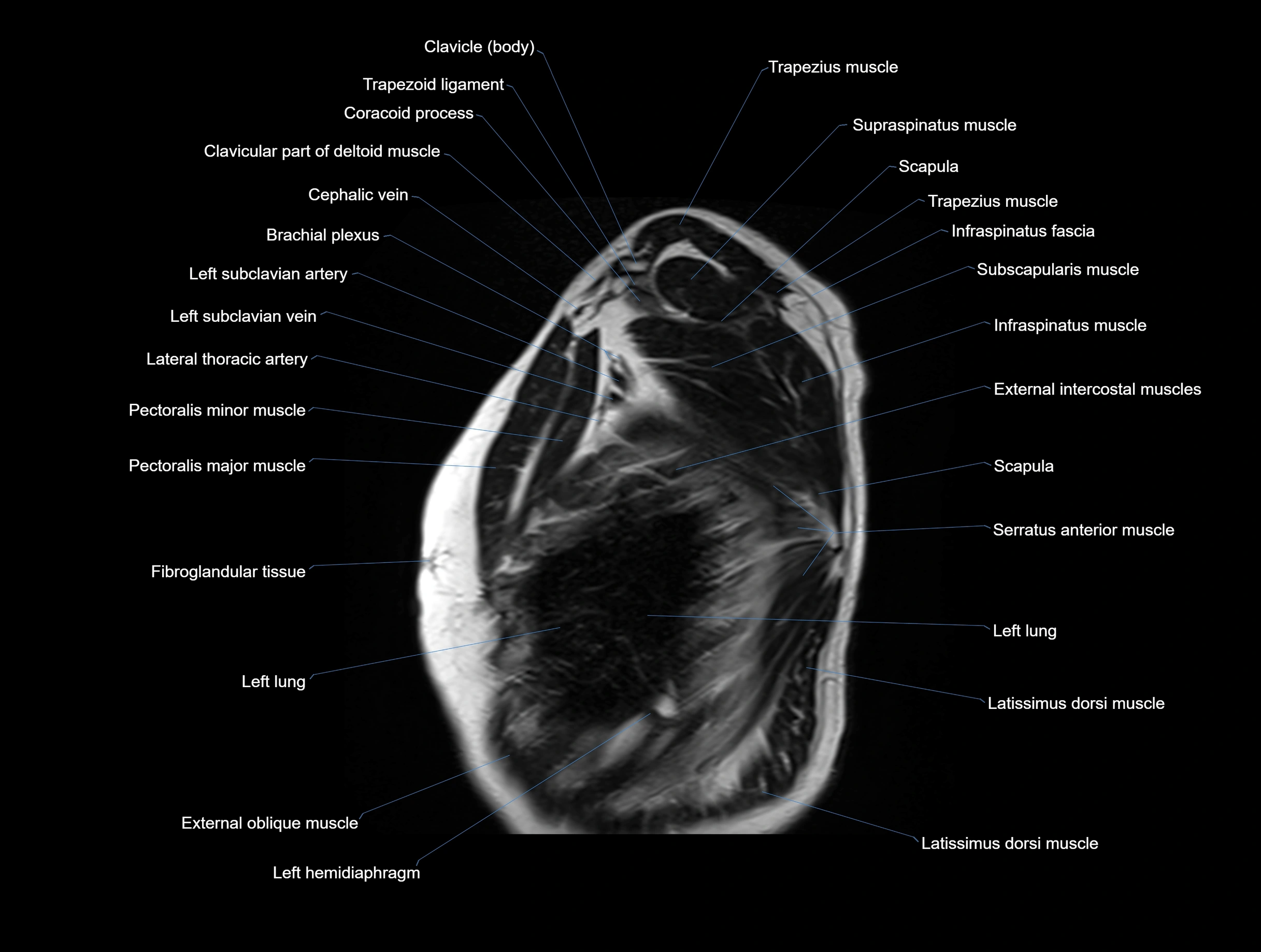 MRI chest (thorax) coronal  cross sectional anatomy 3T radiology  image-img-00001-00033.webp